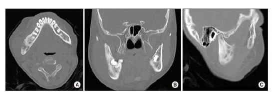 Representative computed tomographic views of chronic recurrent multifocal steomyelitis in jaw case showing the lesion in the right mandible, axial (A), coronal (B), and sagittal (C)
