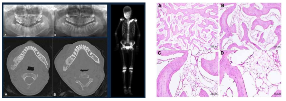 Active bone lesion in the right mandible, L1, left iliac bone, left clavicle, right distal femur and right proximal tibia (좌), Some trabecular bones were thickened and deposited with osteophyticnew bones, butmostof marrow bones were thinned and shortened with the features of gradual bony resorption. These reactive bony reaction was coincident with degenerative fibrous marrow connective tissue slightly infiltrated with chronic inflammatory cells. But diffused granulomatous lesion or inflammatory abscess was not found (우)