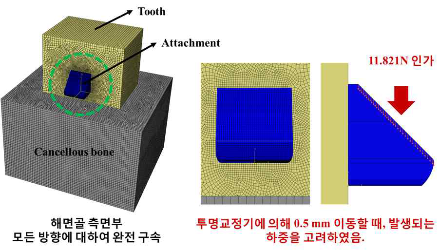 단순 치아 형상을 기반으로 어태치먼트 최적 형상 도출 분석 수행