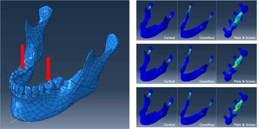 시술 모델의 하중 조건 및 골과 임플란트의 응력 분포