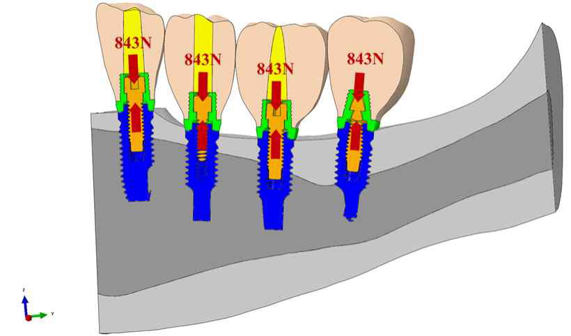 임플란트 구조체의 지대주 나사에서의 압축 하중 인가