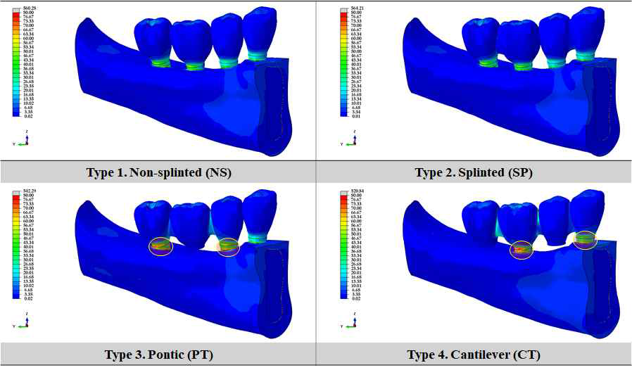 4가지 보철물에 따른 전체 형상의 응력 분포