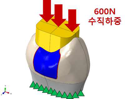 치아 직접 수복물의 3차원 유한요소모델의 경계 및 하중조건