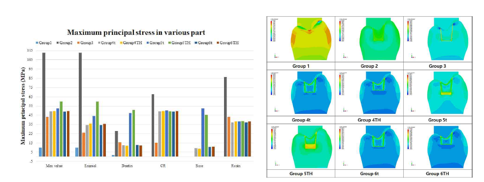 수복물 종류 별 유한요소해석의 최대 주응력 결과