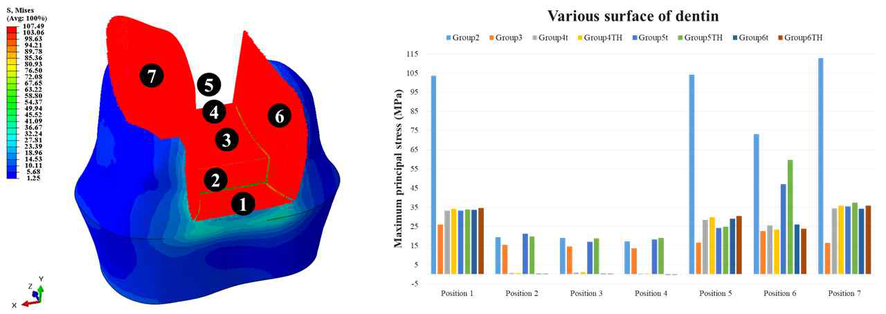 직접 수복물 내부의 치아와 접촉되는 영역별 응력 비교