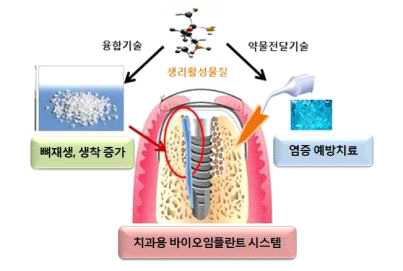 치과용 바이오임플란트 (출처: 바이오 임플란트 기술개발 등 연구개발(R&D) 추진, 미래부)