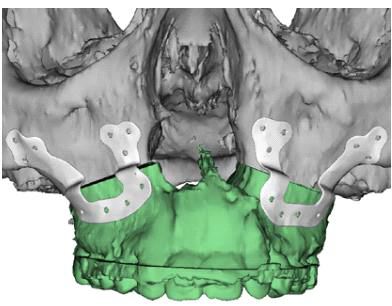 미국의 양악수술용 환자맞춤형 CAD/CAM 뼈고정 임플란트