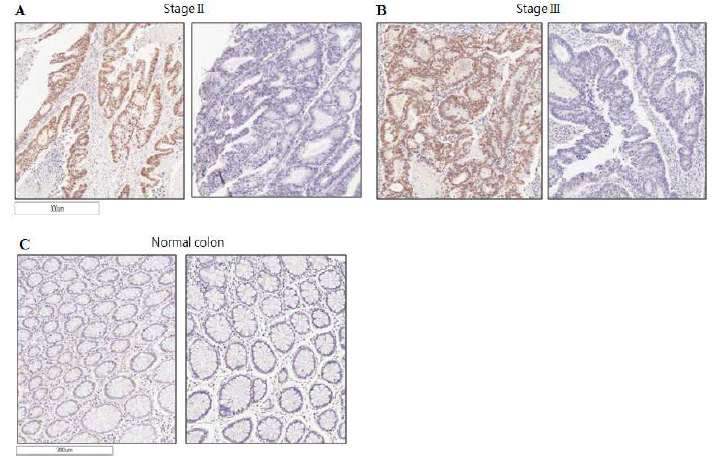 대장암 및 정상조직에서 KSRP의 면역염색