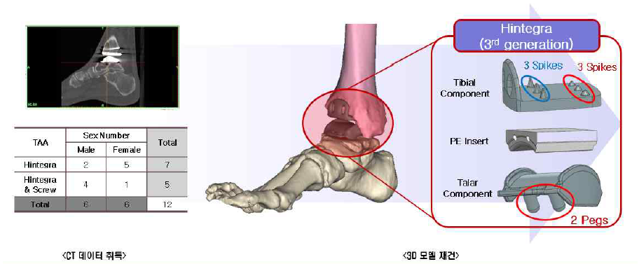 인공발목관절 시술 후 재수술 환자에 대한 3D 모델 재건 프로세스