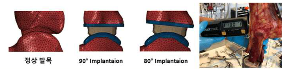 2차 발목관절 실험 조건 및 Implantaion 조정