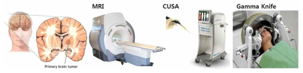 뇌종양 진단, 치료 장비와 시술