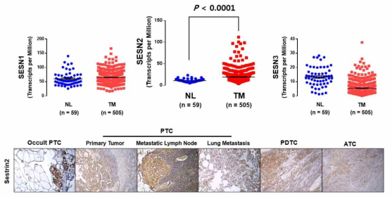 갑상선 암에서 Sestrin2의 과발현 (TCGA: thyroid cancer, n = 505/환자 갑상선 암 조직)