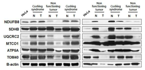 기능성 및 비기능성 부신 종양에서 OxPhos의 발현 (N=Normal, T=Tumor)