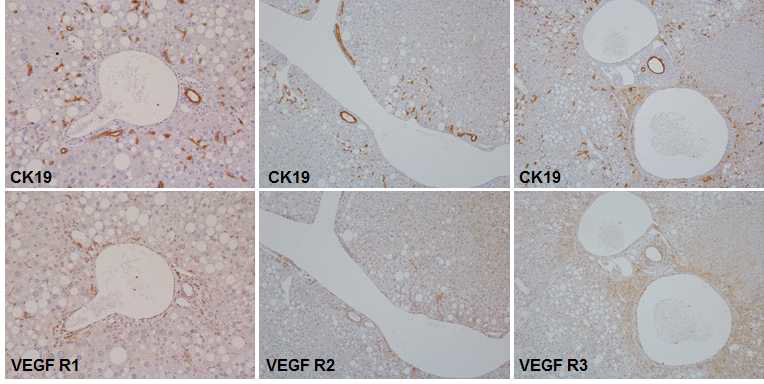 CK19과 VEGF receptor의 발현