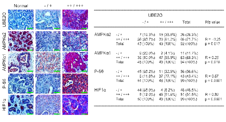 암환자 샘플에서 UBE2-AMPK-mTOR-HIF1 신호 전달 조절