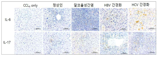 간질환 아바타 마우스 간조직 내 IL-17발현 증가