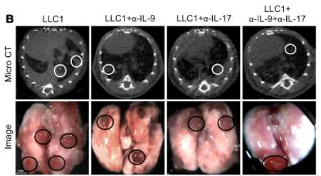 Neutralization of IL-9 (anti–IL-9) and IL-17 (anti–IL-17) reduces tumor metastasis to the lung