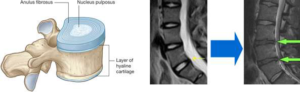 퇴행성 디스크는 수핵 (nucleus)내 수핵세포, 당단백, 2형 교원질 감소에 의한 수분 함유량 감소에 의해 발생