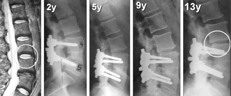 척추 수술 후 증후군 요추. 4-5번 유합술 당시에는 요추 3-4번 디스크는 정상이었으나, 수술 후에 시간이 지남에 따라 척추유합 인접 위 부위에 심한 추간판퇴행성 변화가 발생하여 추간판 간격 감소하여 심한 요통 재발