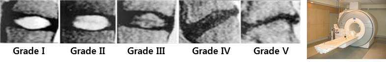 MRI 영상이미지를 통한 퇴행성 추간판 등급 검증(Pfirrmann) 및 분당차병원 MRI 장비