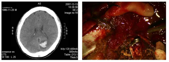 감염성 심내막염 합병증으로 뇌출혈이 생긴 환자의 CT 소견 및 뇌수술 사진