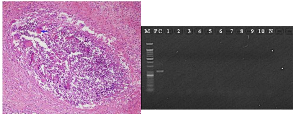 간에 생긴 mucormycosis 환자에서 병리 소견(왼쪽)과 10명의 대조군 환자에서 포르말린에 고정된 간조직에서 PCR 시행 결과(모두 음성으로 확인됨)