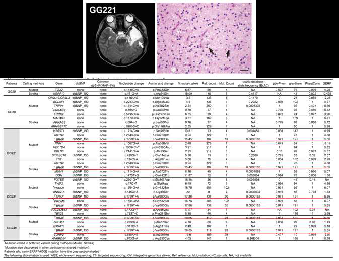 Ganglioglioma (GG) 환자에서 난치성 뇌전증을 일키는 종양 부위를 절제한 후 MRI 및 조직 병리 사진 (위). 5명의 GG환자의 뇌-혈액 조직쌍을 deep whole exome sequencing 한 후 somatic variant를 발굴하는 알고리듬인 Mutect 및 Strelka로 분석한 결과 3명의 환자 (60%)에서 BRAV V600E somatic mutation이 발굴됨(붉은색 밑줄)