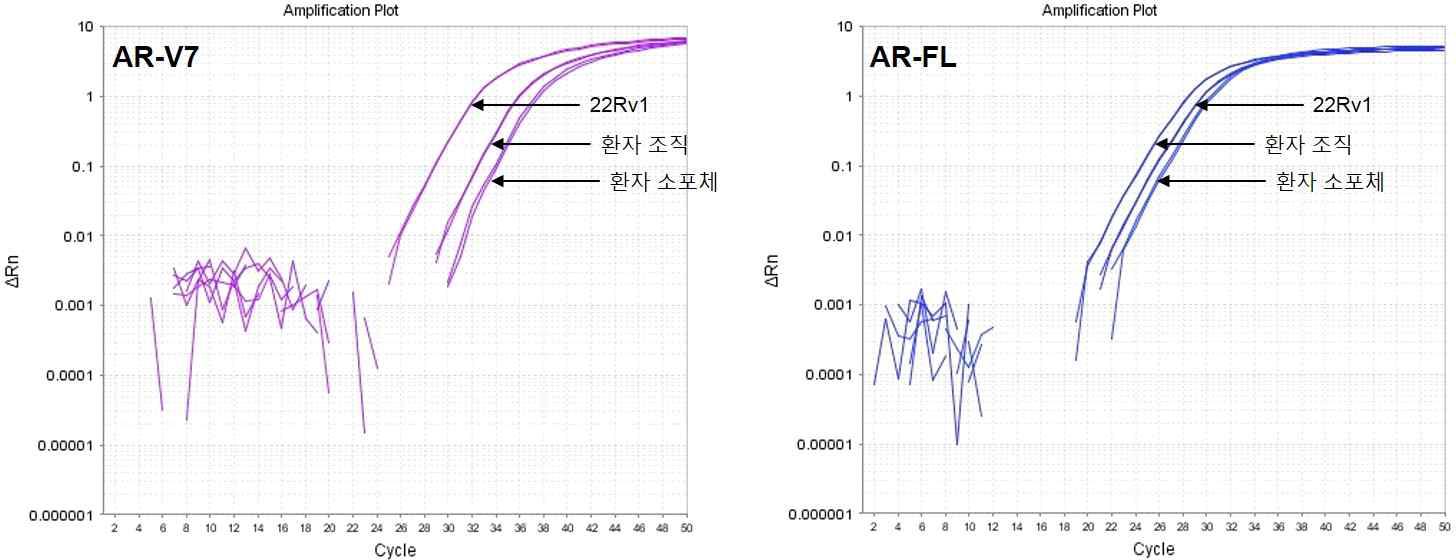 호르몬 불응성 전립선암 내 AR-V7 발현 분석