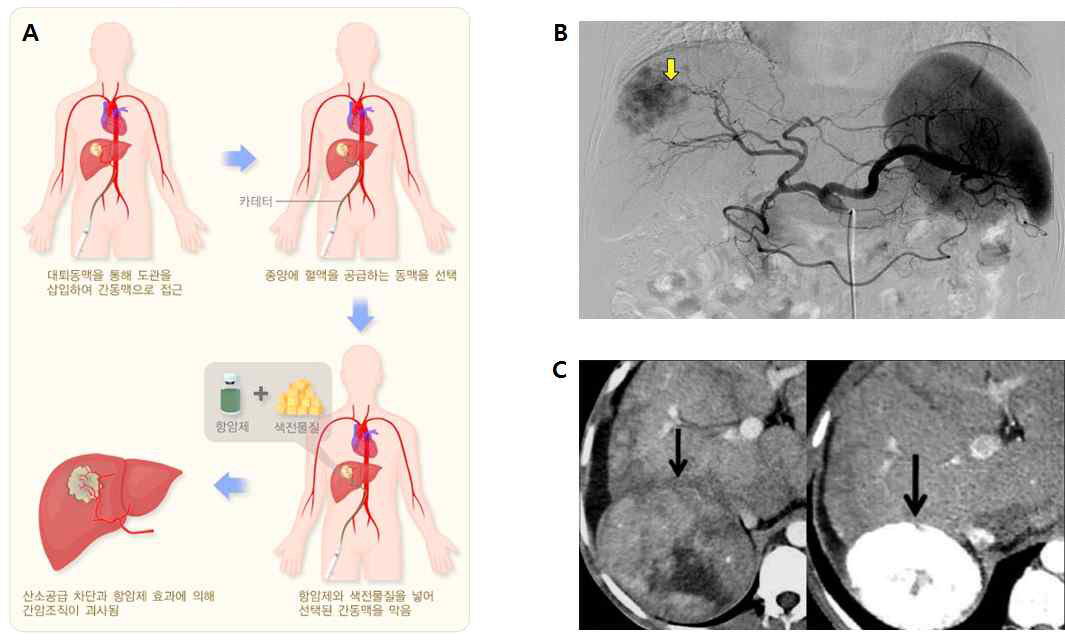 (A) 화학색전술의 과정. (B) 화학색전술 도중 얻은 혈관조영술 사진. 간 우엽에 과혈관성의 간암이 (화살표) 보임. (C) 치료 전 (좌) 과 후 (우) 의 CT 검사에서 간암의 변화가 관찰됨. 화학색전술 도중 주입한 Lipiodol 이라는 색전물질이 CT에서 밝게 (high attenuation) 관찰되며, 종양의 크기도 이전과 비교해서 줄어듦