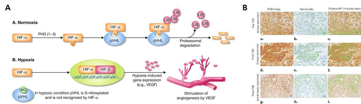 (A) 저산소증 → HIF-1α → angiogenesis 로 가는 pathway 의 모식도. (B) 화학색전술 전후의 종양 조직 비교 시, 화학색전술 후에 HIF-1α 가 과발현됨을 알 수 있음