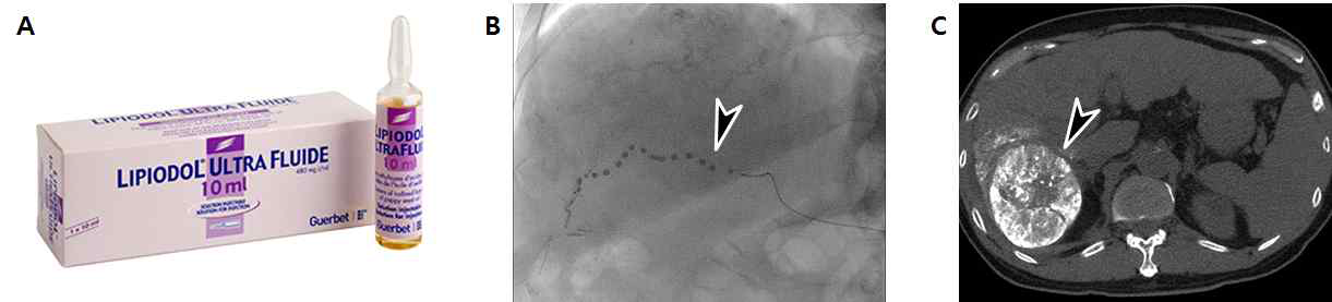 (A) Lipiodol 의 시제품 (B) 화학색전술 시술 중 사진. 간동맥내 거치된 미세카테터를 통해 Lipiodol emulsion 들이 종양으로 향하는 것이 보임 (화살촉). (C) 시술 후 CT에서 종양 내 Lipiodol 이 축적되어 있음 (화살촉)