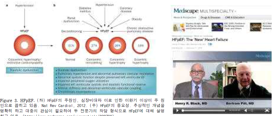 HFpEF. (좌) HFpEF의 주원인, 심장비대와 이로 인한 이완기 이상이 주 원인으로 꼽히고 있음. Nat Rev Cardiol, 2012. (우) HFpEF의 중요성. 추상적인 개념을 명확히 하고 대중의 관심이 필요하여 두 전문가의 좌담 형식으로 HFpEF에 대해 설명하고 있음. (http://www.medscape.com/viewarticle/838790)