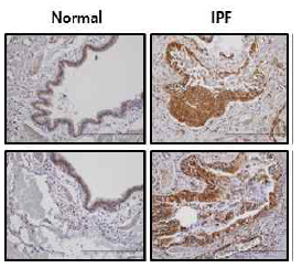 IPF 환자 폐조직에서 p300의 발현 확인
