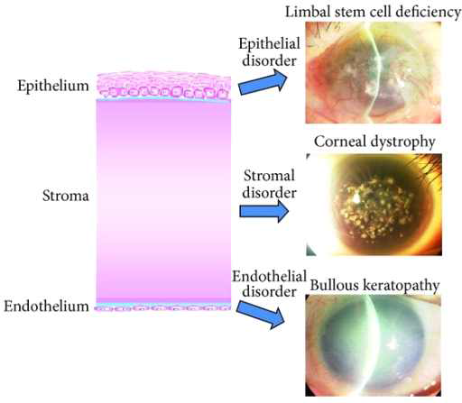 각막 구조 및 각 층의 손상에 따른 질환