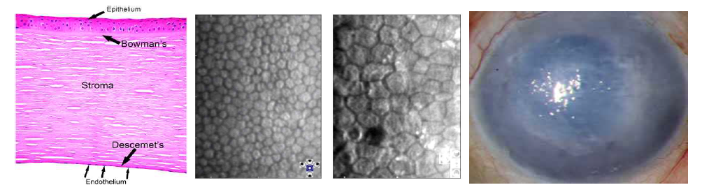 각막의 다층 구조와 내피세포 (endothelium) 위치 (A), 각막내피세포의 정상 형태 (B), 각막 내피손상에 의해 보상성 확장이 일어난 경우 각막내피세포의 형태 (C), 각막내 피세포 손상에 의해 각막 부종 및 대상 부전이 발생한 경우 (D)