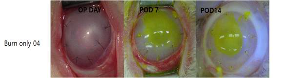 Sodium fluorescein로 염색하여 각막의 손상 확인