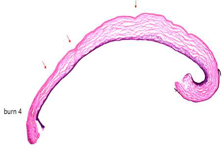 손상된 각막 상피의 조직염색 사진. 화살표 부분이 알칼리 손상으로 인하여 각막 상피가 소실된 부분임