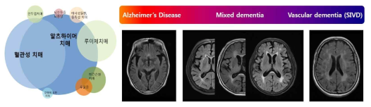 임상적으로는 알츠하이머 치매와 혈관성 치매의 양극단의 특성을 보이는 전형적인 환자보다는 두 가지 치매 특성을 동시에 가지고 있는 혼합형 치매(mixed dementia) 형태를 보이는 환자가 매우 많으며, 혈관성 질환을 공유한 알츠하이머 치매(Alzheimer disease with cerebrovascular disease)라고 부르기도 함