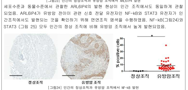 인간의 정상조직과 유방암 조직에서 NF-kB 발현