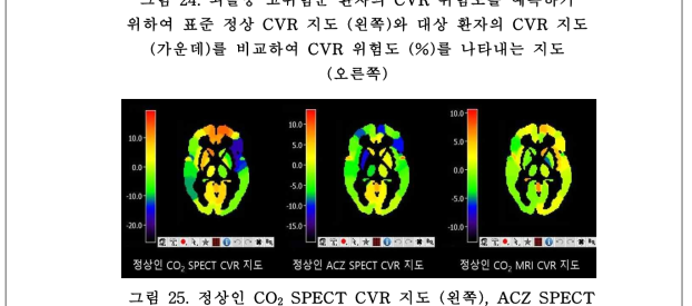 정상인 CO SPECT CVR 지도 (왼쪽), ACZ SPECT2