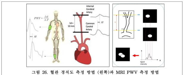 혈관 경직도 측정 방법 (왼쪽)과 MRI PWV 측정 방법