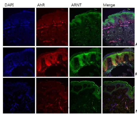 아토피피부염, 건선 환자의 병변에서 AhR, ARNT 발현이 증가됨