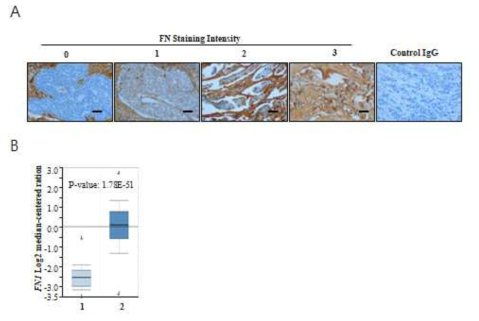 유방암 환자 조직에서 FN 발현 비교