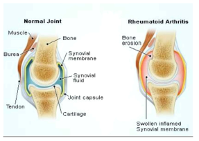 정상관절 및 류마티스 관절염 비교