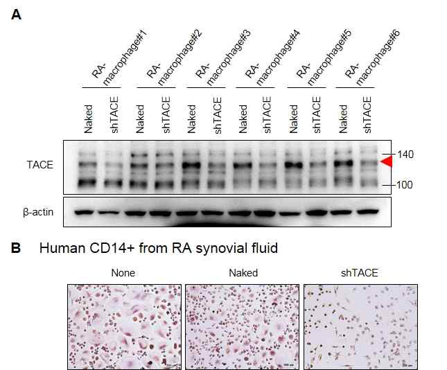 RA 환자 관절활액의 Macrophage 세포에 Naked와 shTACE 유전자 전달 후, A: 단백질 수준 분석함. B: 파골세포 분화 억제를 TRAP 염색으로 확인함