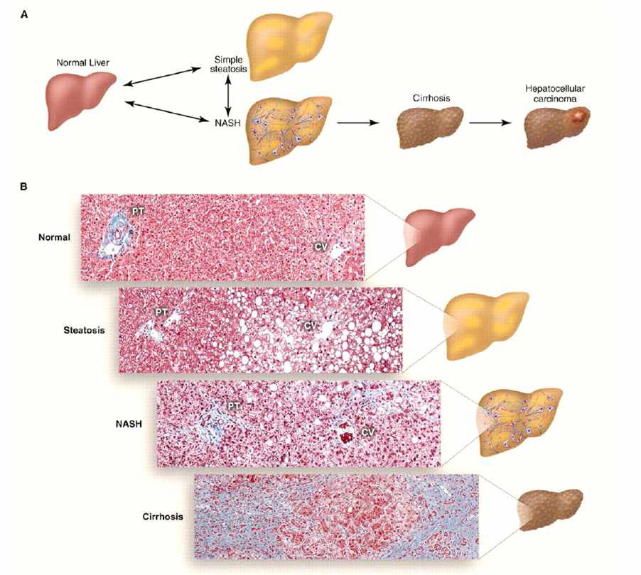 지방간의 단계별 모양(A) 및 병리 소견(B)