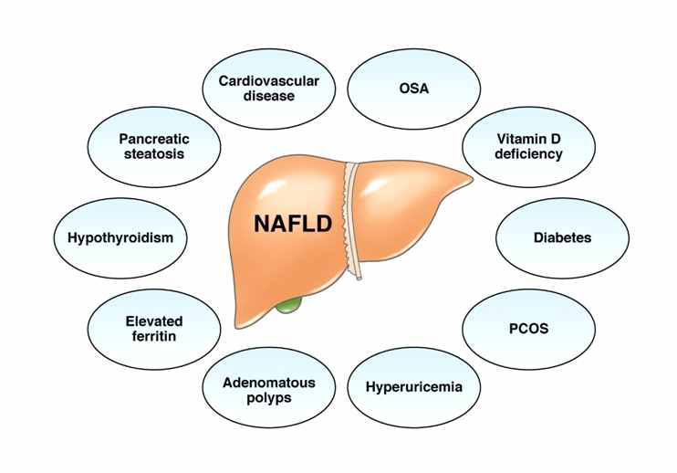 비알코올 지방간 관련 질환