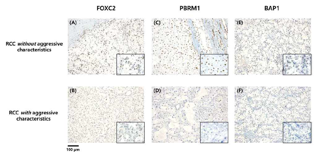 Immunohistochemical findings of FOXC2, PBRM1, and BAP1 (A) Positive expression of FOXC2 (B) Negative expression of FOXC2 (C) Positive expression of PBRM1 (D) Negative expression of PBRM1 (E) Positive expression of BAP1 (F) Negative expression of BAP1, Scale bars indicate 100 μM (originalmagnification x100; inset x400)