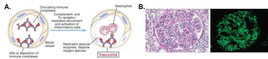 루푸스 발병은 제3형 과민반응에 의함. A, 면역복합체에 의한 제3형 과민 반응. B. 루푸스환자의 사구체에 침윤된 면역복합체(Abbas 등, Cellular and Molecular Immunology, 7th Ed.에서 발췌)