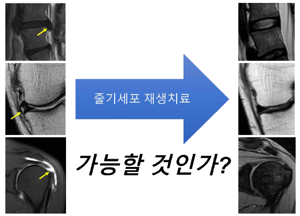 근골격계 질환/통증과 연부조직에 대한 줄기세포 재생치료의 의의